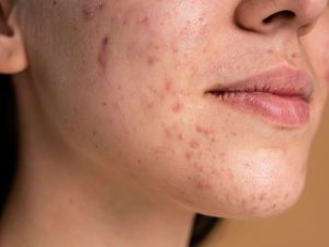 Psoriasis