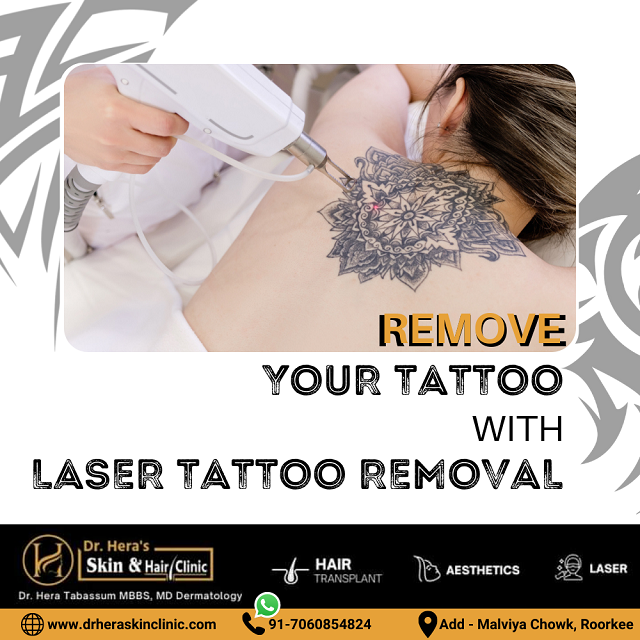 What's the best tattoo removal procedure? - YouTube
