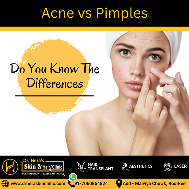Acne vs Pimples