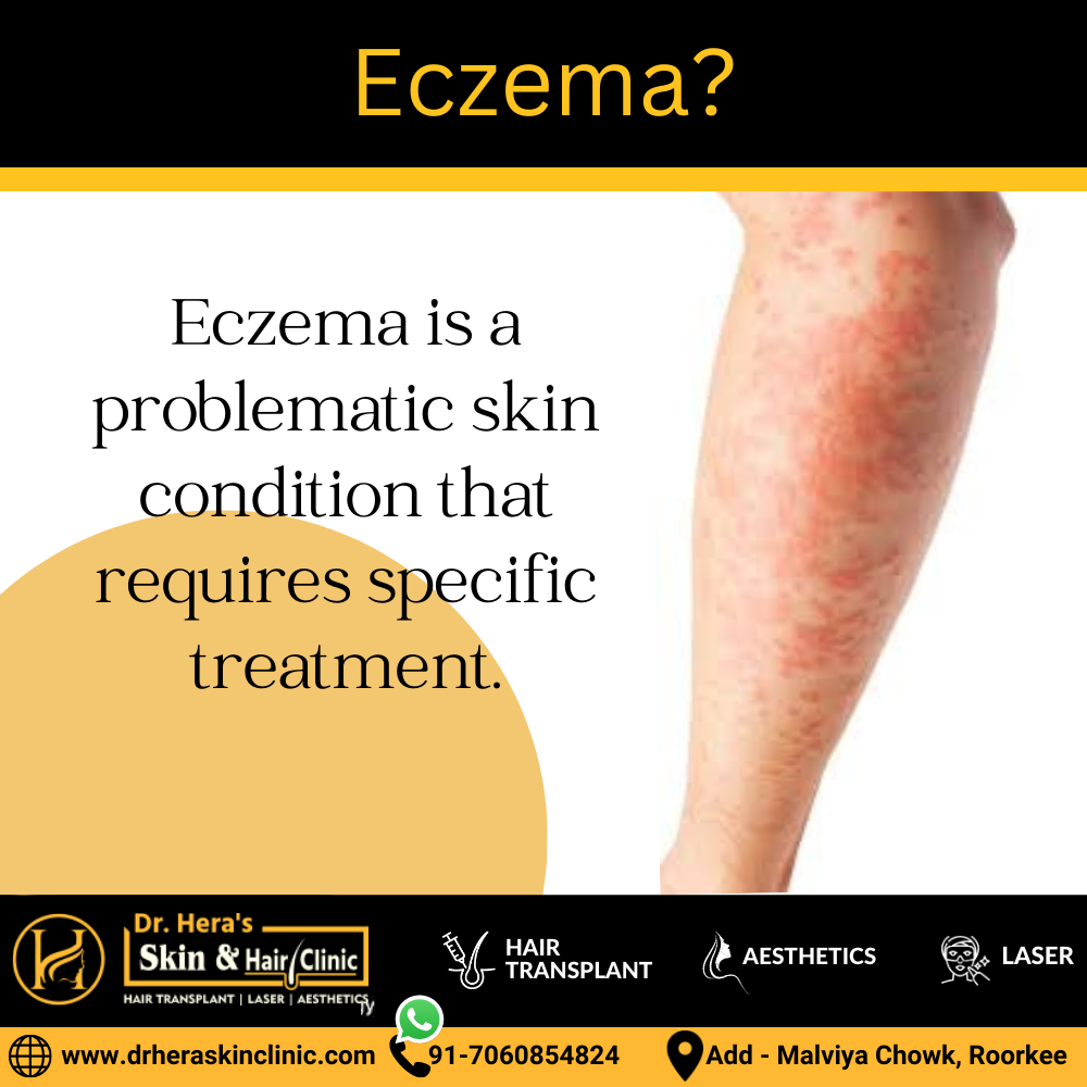 Eczema Treatment in Roorkee