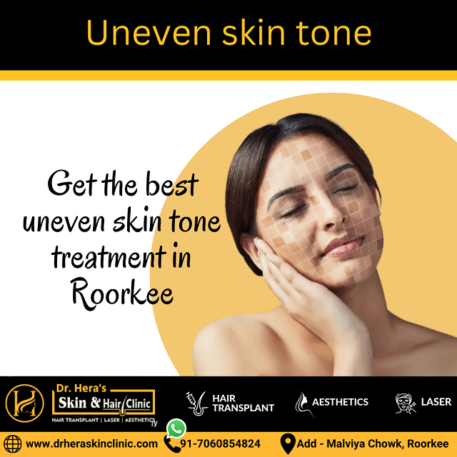 Uneven skin tone treatment in Roorkee