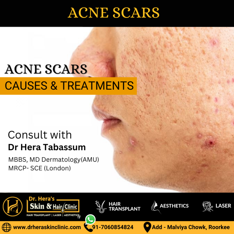 Acne Scars Causes And Treatments Dermatologist In Roorkee