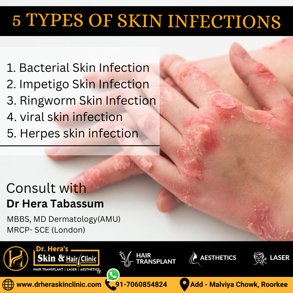 What are the 5 types of skin infections? - Dermatologist in Roorkee