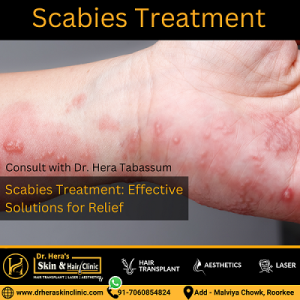 Scabies Treatment At Dr Hera Skin Hair Clinic Dermatologist In Roorkee