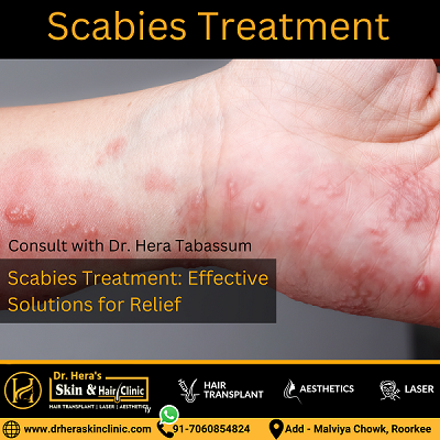 Scabies Treatment At Dr Hera Skin & Hair Clinic - Dermatologist In Roorkee