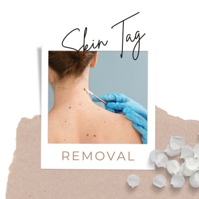 Skin Tag Removal