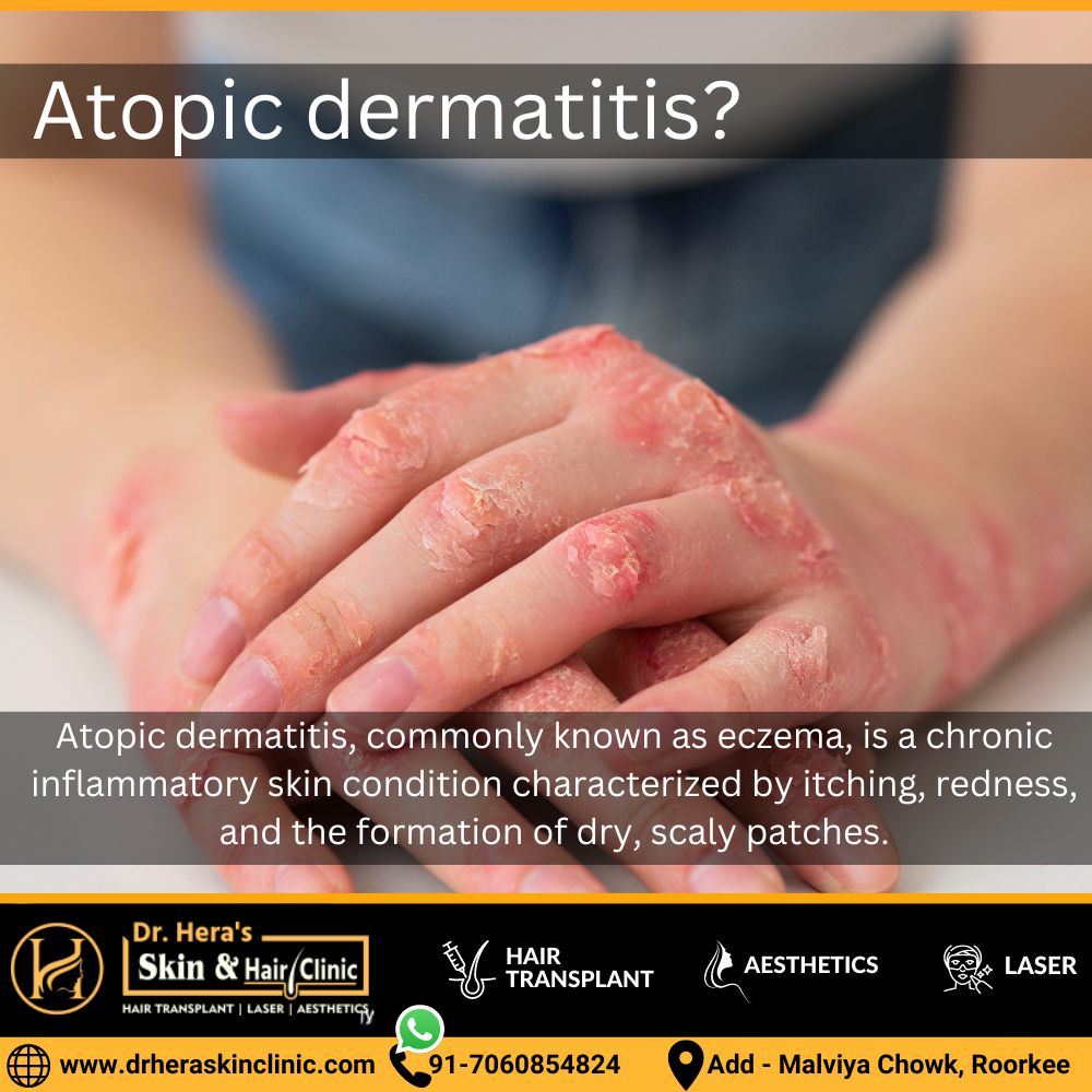 Atopic dermatitis treatments