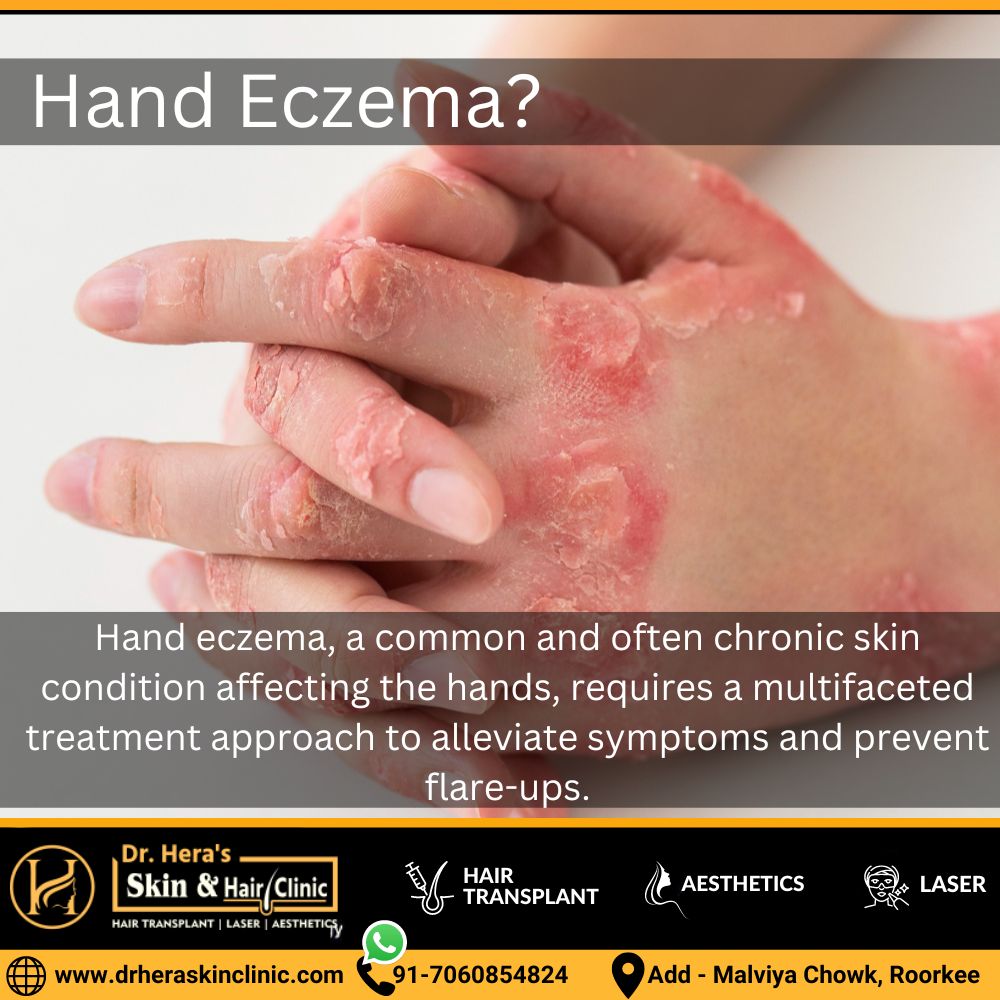 Hand Eczema Treatments