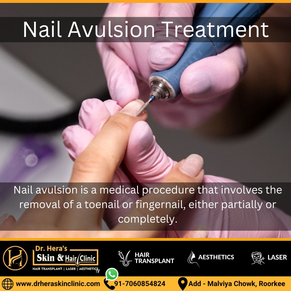 Nail Avulsion Treatment in Roorkee