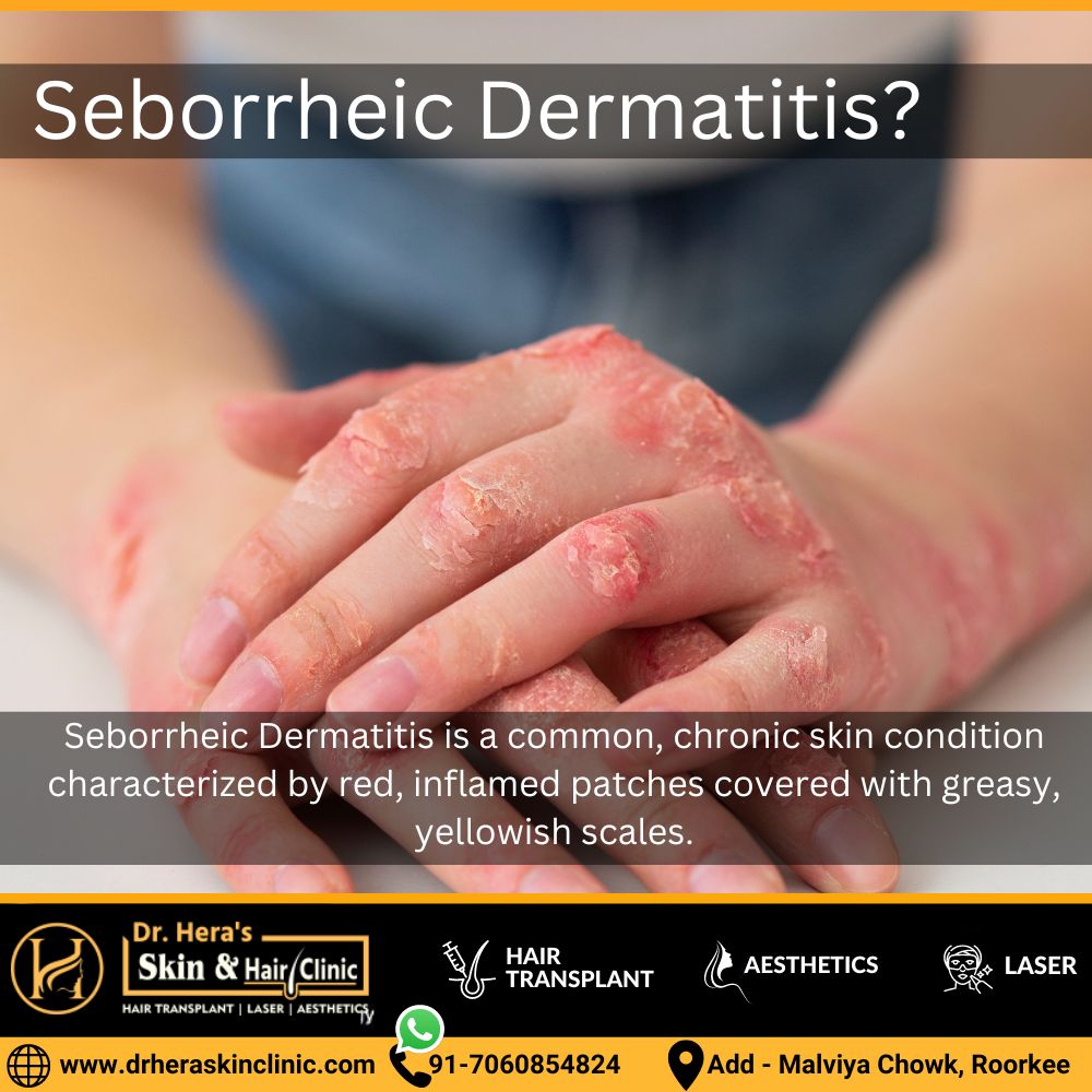 Seborrheic Dermatitis Treatment