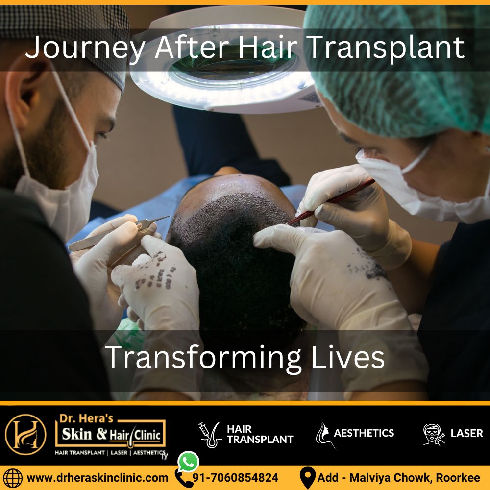 After Hair Transplant