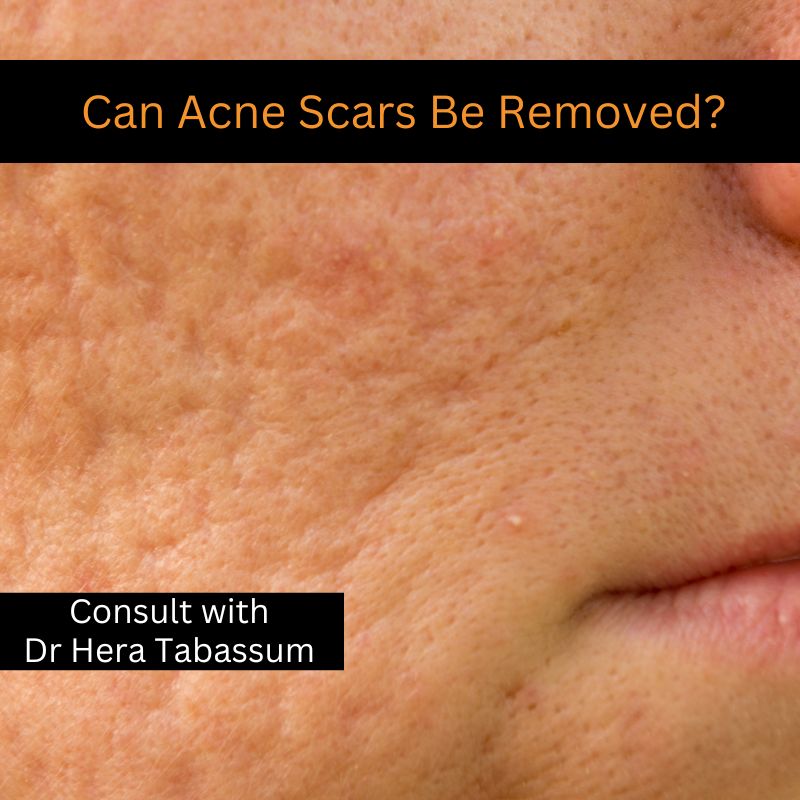 Can Acne Scars Be Removed