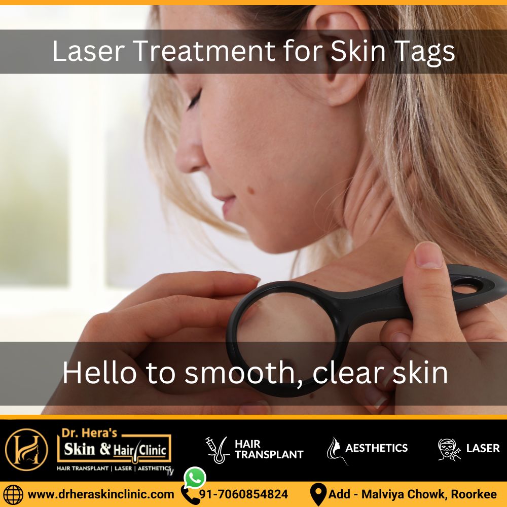 Laser Treatment for Skin Tags
