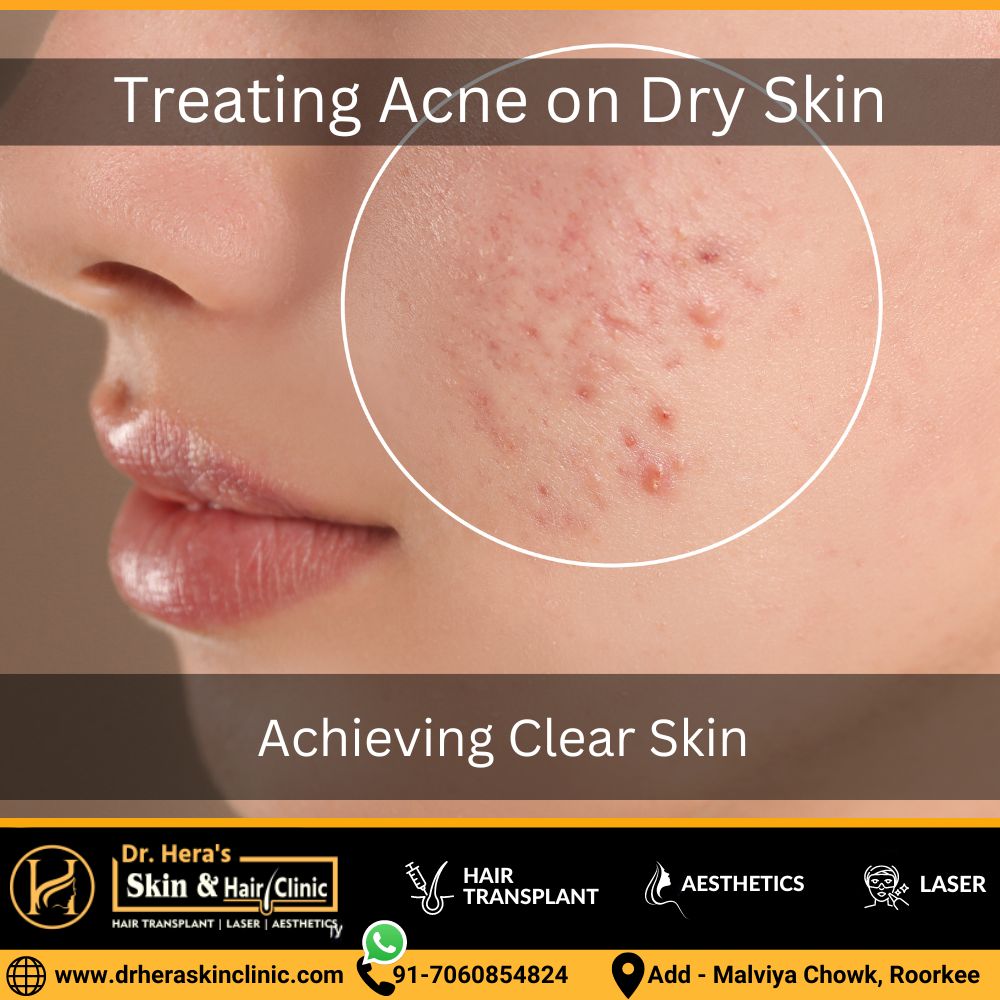 Treating Acne on Dry Skin