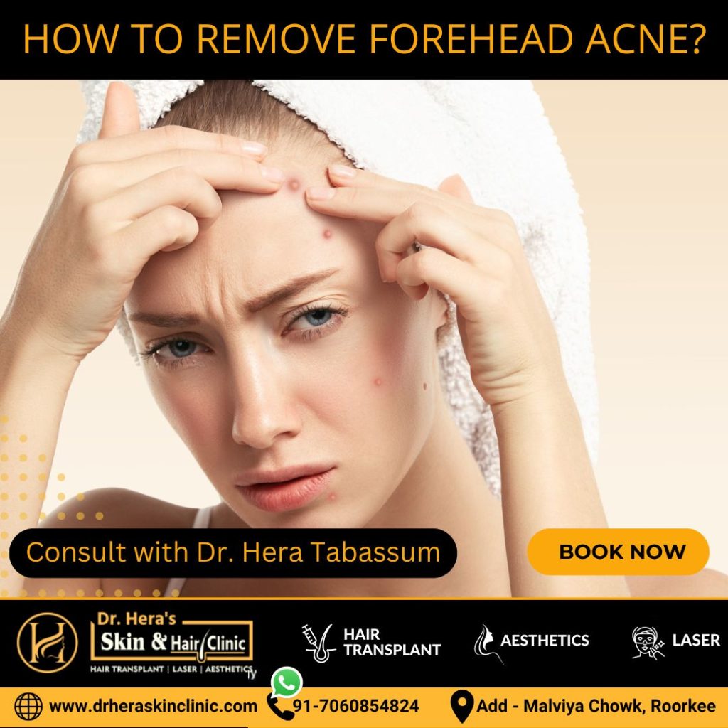 Remove Forehead Acne