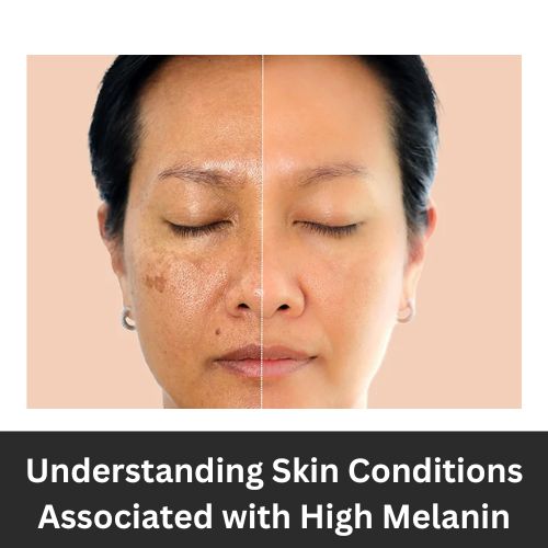 Understanding Skin Conditions Associated with High Melanin