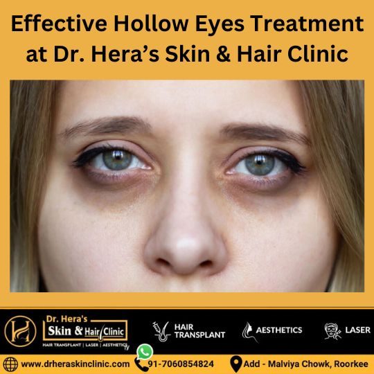 Hollow eyes treatment