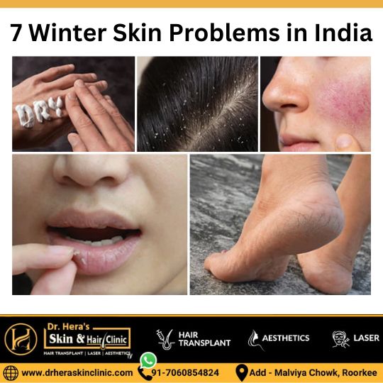 7 Winter Skin Problems in India