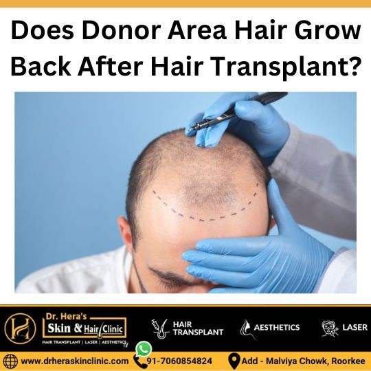 Hair Grow Back After Hair Transplant