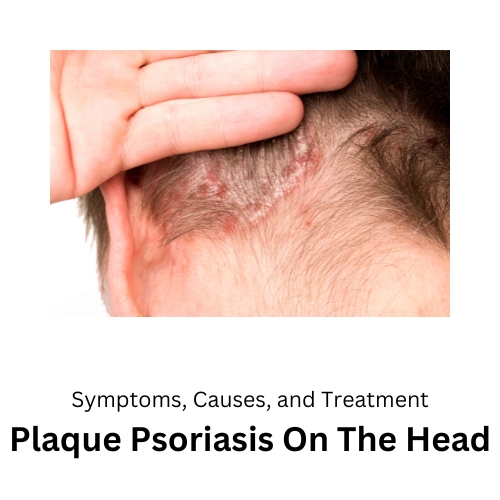 Plaque Psoriasis On The Head