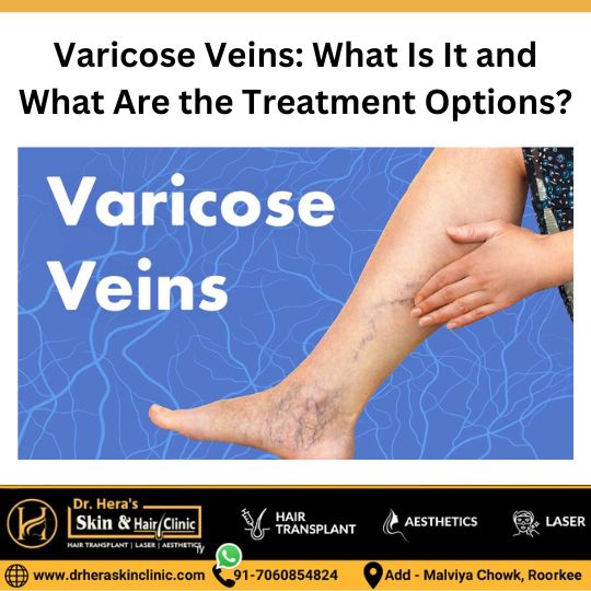 Varicose veins