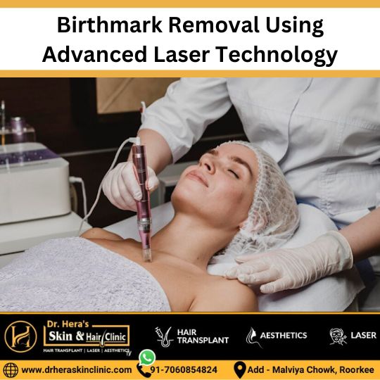 Laser Birthmark removal treatment