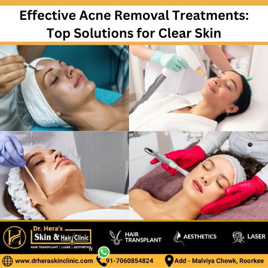 Effective acne removal treatments