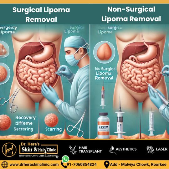 Surgical vs non surgical lipoma removal