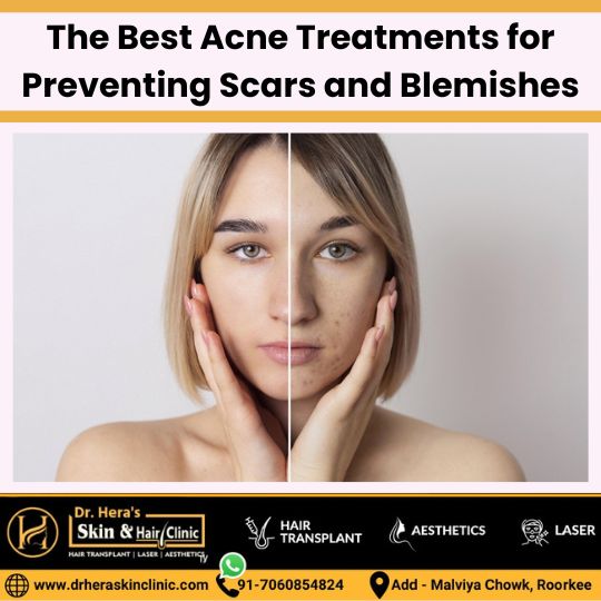 Acne treatments for preventing scars and blemishes