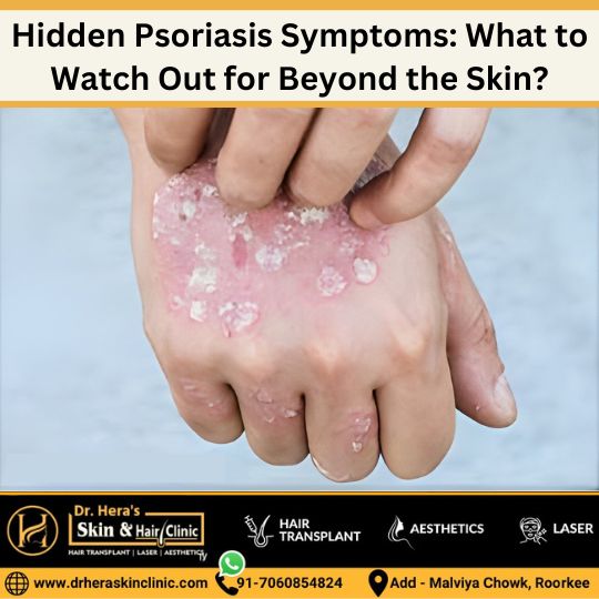 hidden psoriasis symptoms