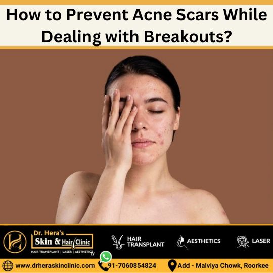 preventing acne scars during breakouts