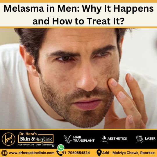 melasma in men