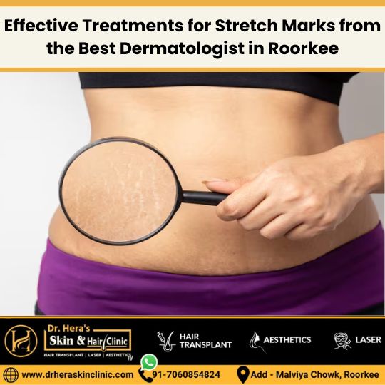 Effective Treatments for Stretch Marks
