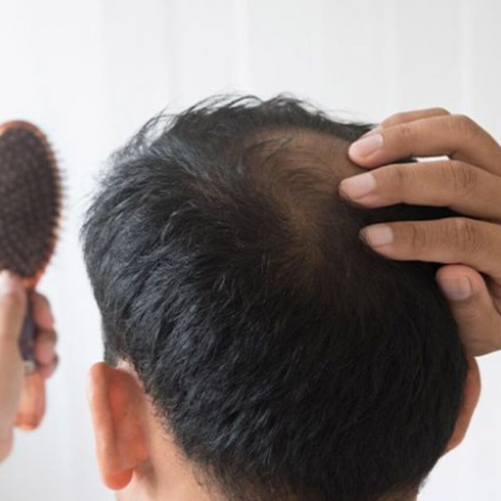 How to Stop Hair Loss in Men: Expert Tips for Natural Regrowth