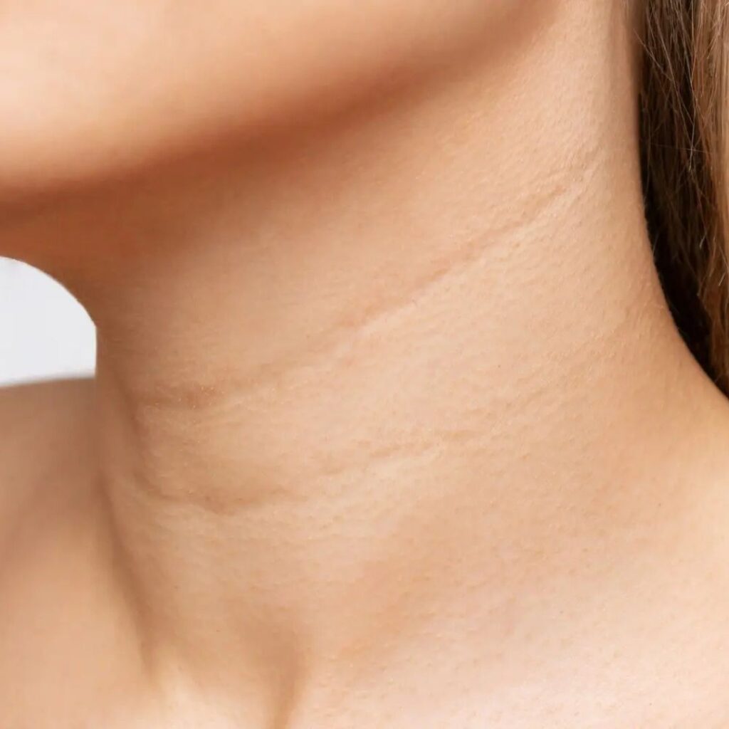 How to Get Rid of Neck Lines Naturally