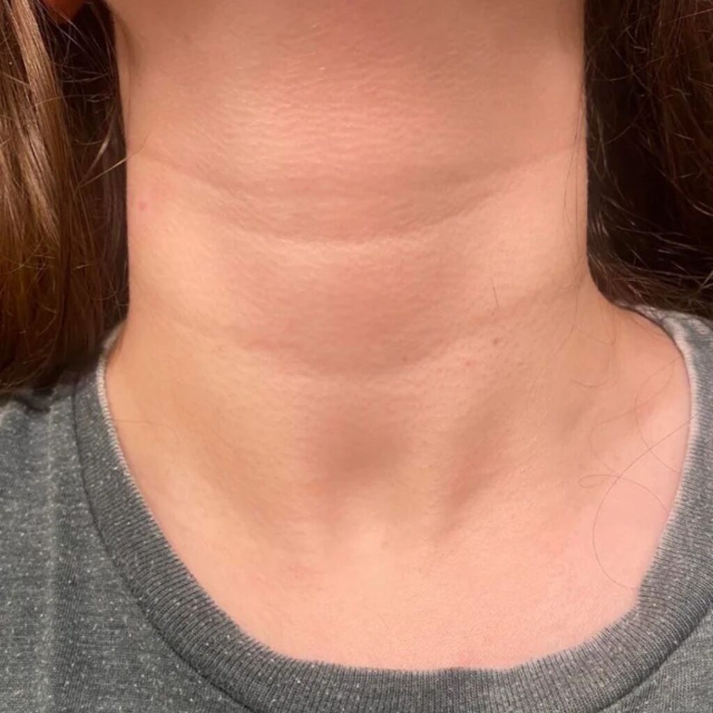 How to Remove Neck Lines Permanently