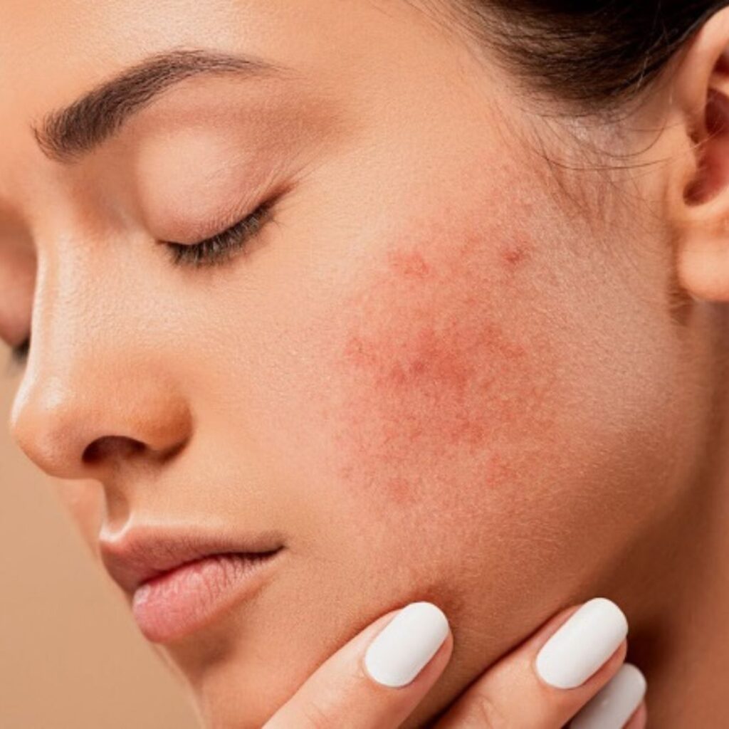 Why Some Acne Scars Don’t Fade & What Can Be Done