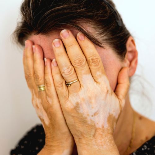 The Role of Immunity in Skin Disorders like Vitiligo and Psoriasis