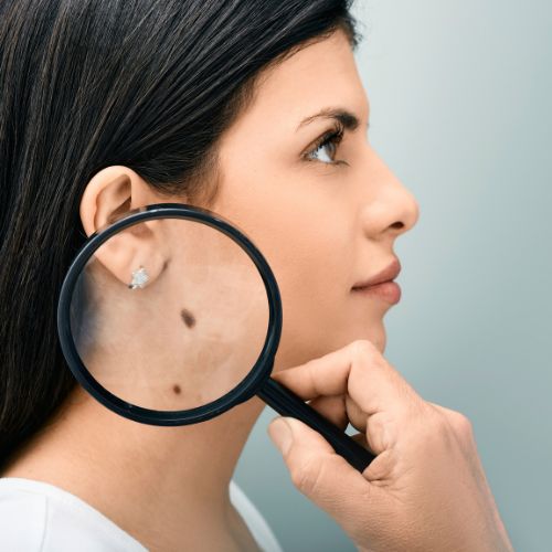 Mole vs. Skin Tag: How to Tell the Difference