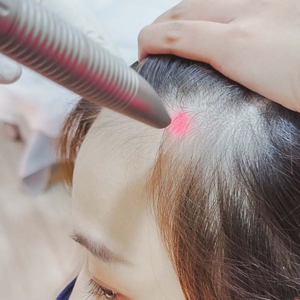 Does Laser Hair Regrowth Actually Work?