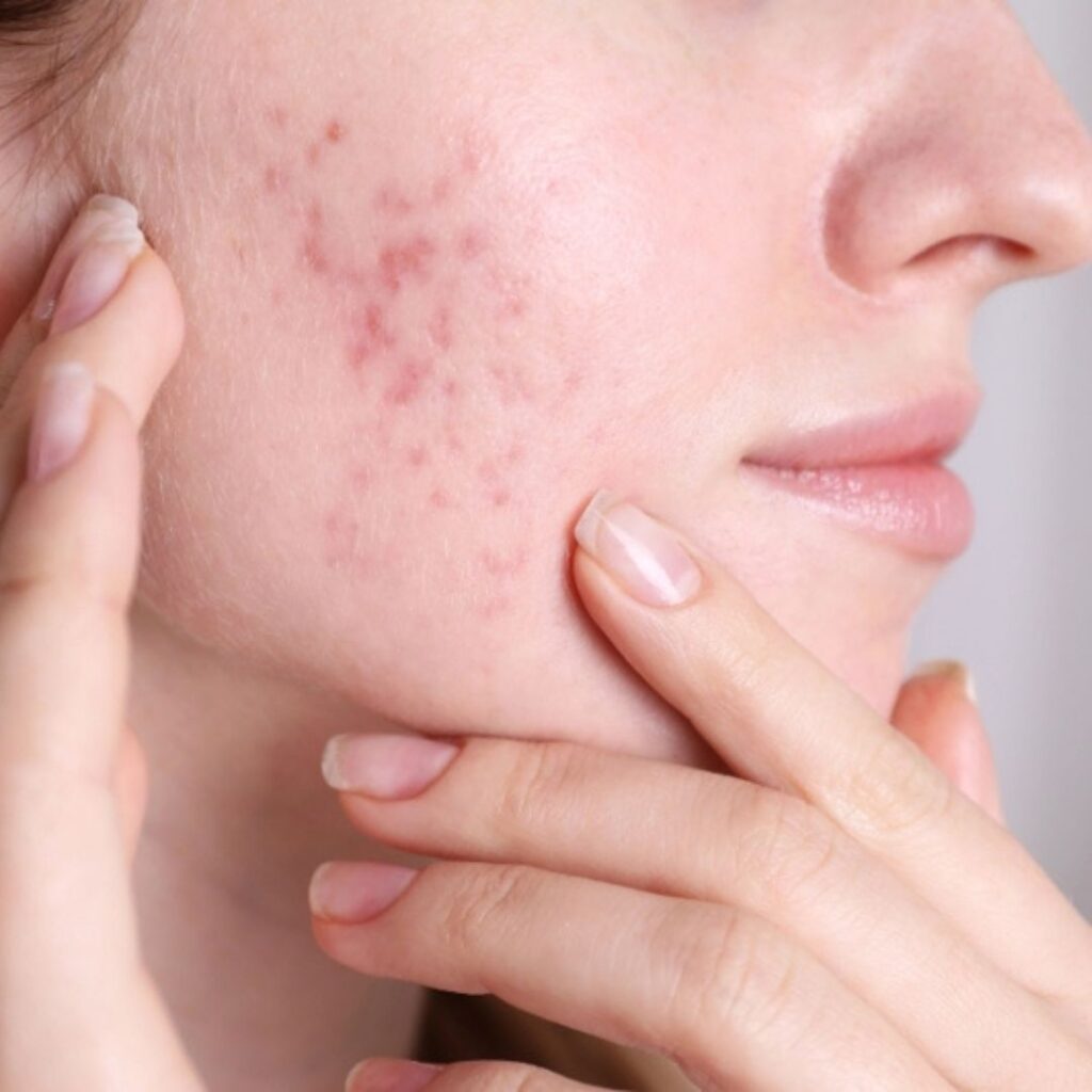 Is CO2 Laser Effective for Deep Acne Scars?