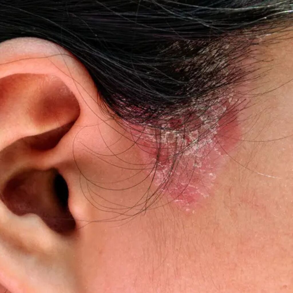 How Long Does It Take to Cure Ringworm Completely?