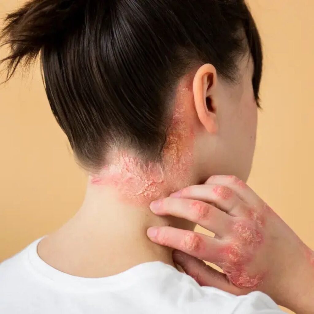 Can Fungal Infection Be Treated Permanently