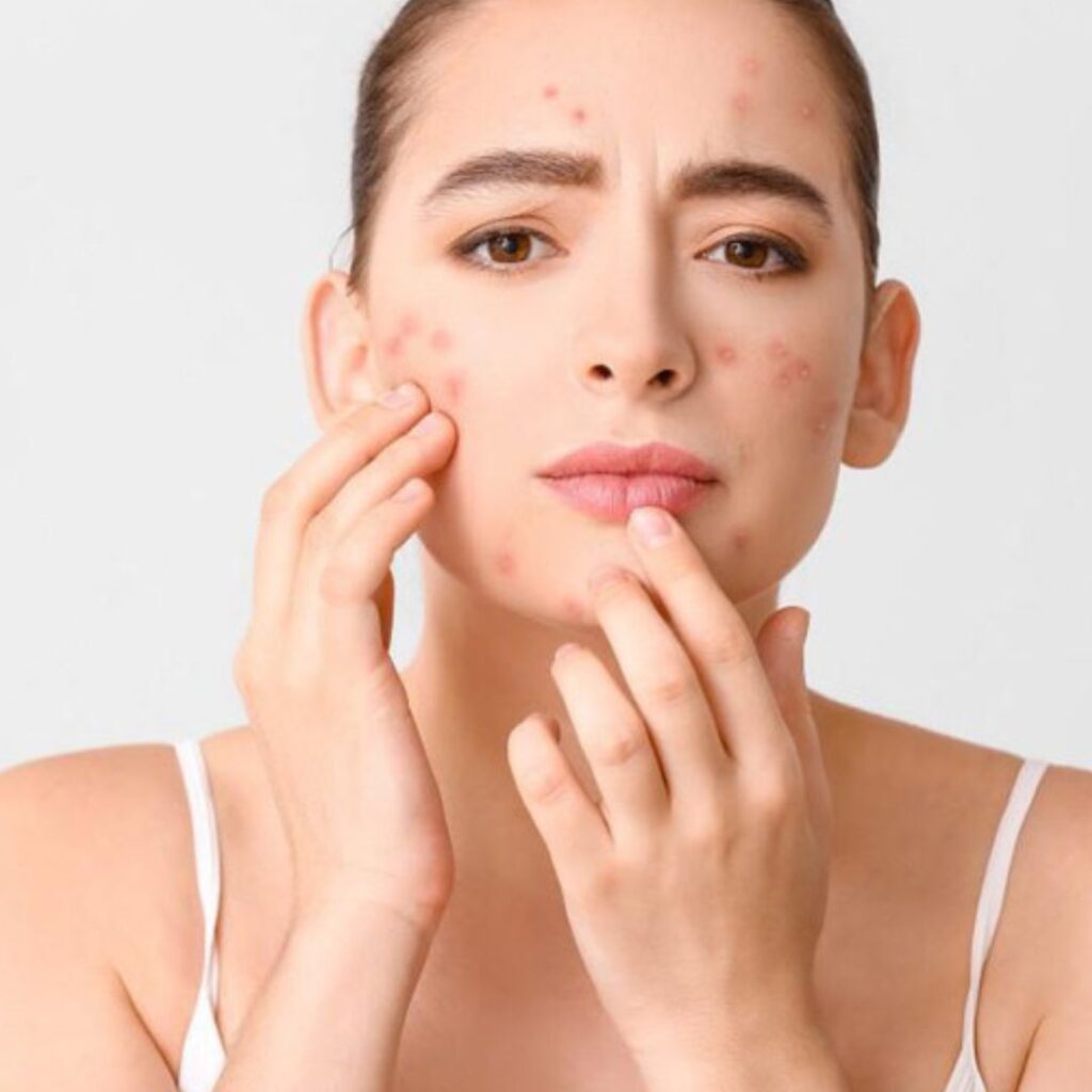 The Role of Gut Health in Persistent Acne & Pimples
