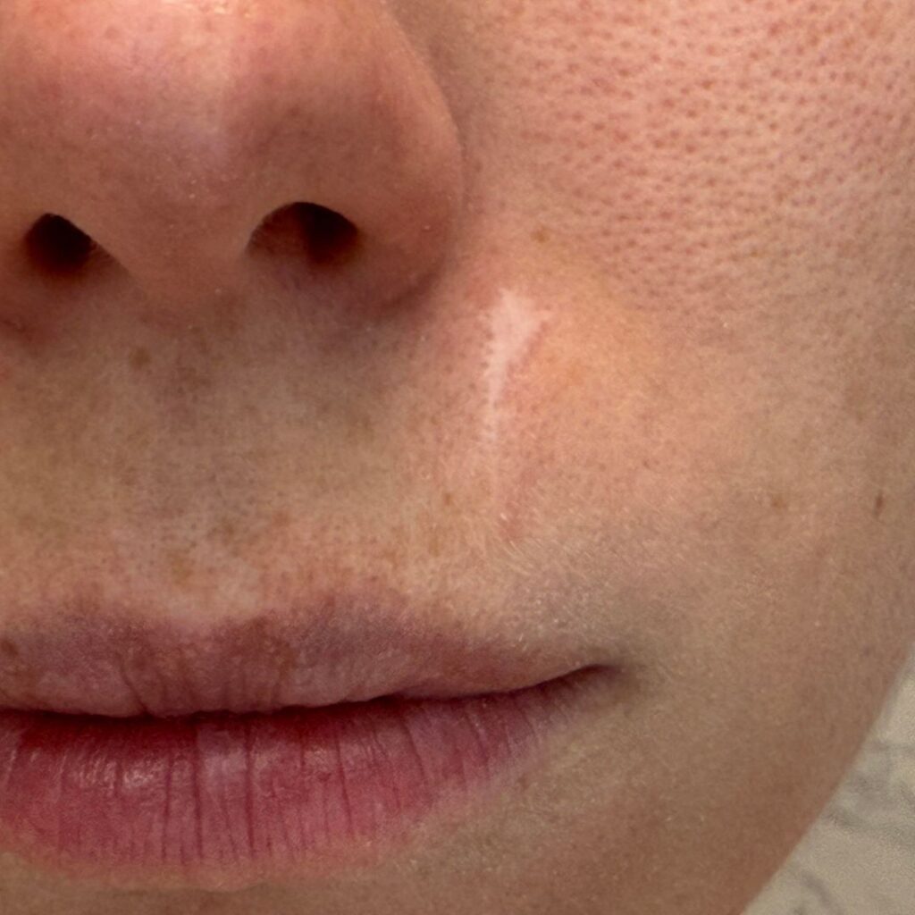 Role of Sun Protection in Long-Term Scar Lightening