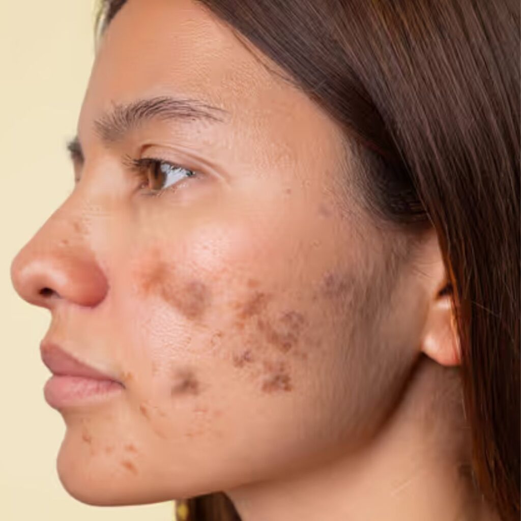 Natural Botanicals Backed by Science for Pigmentation Control