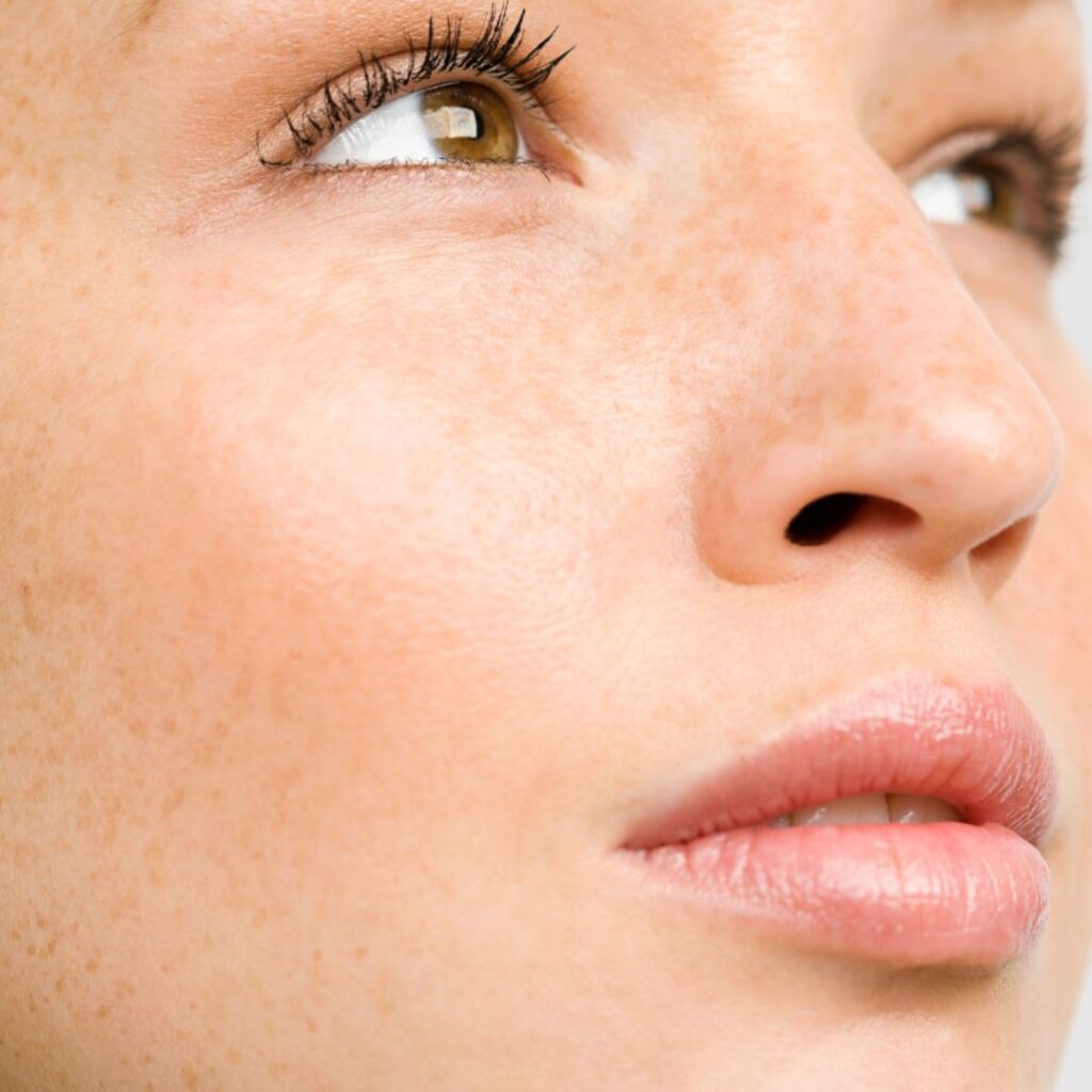 What Is the Best Treatment to Remove Pigmentation?