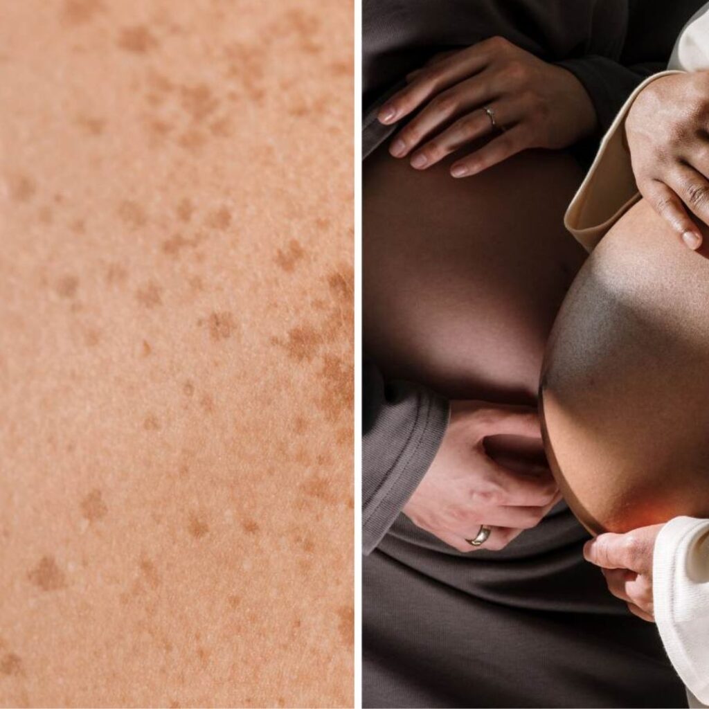 How to Treat Hyperpigmentation During Pregnancy