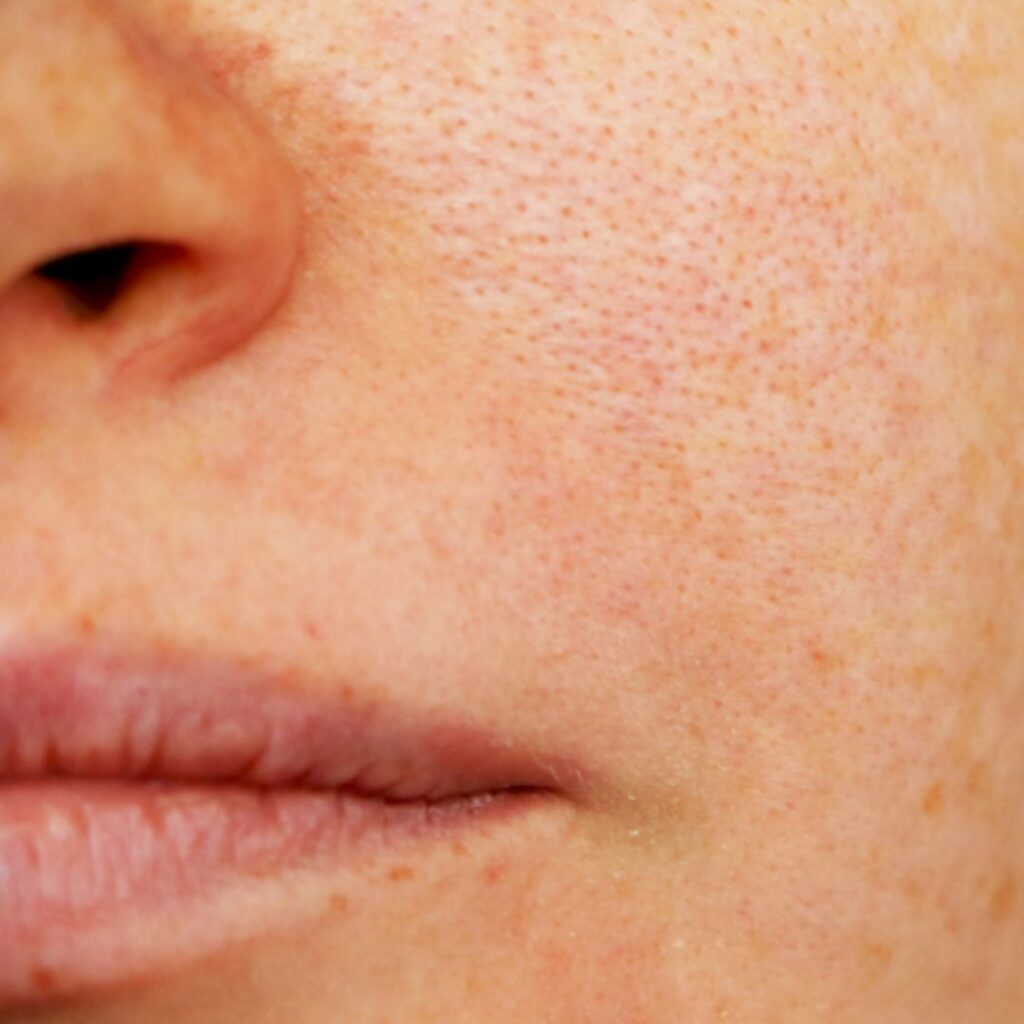 How to Remove Pigmentation from Face Permanently