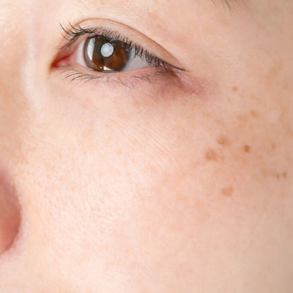 Can Dark Spots Be Removed Permanently?
